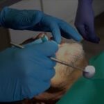 Fillings and Cleanings Newmarket – Keep My Smile Healthy