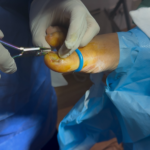 Ingrown Toenail: Fast Relief with Expert Same‑Day Care