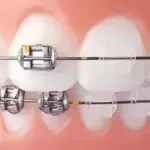 Conroe Dental Implants: Rebuild Your Smile with Confidence