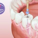 Implantes Dentales Gines: Somriure segura i durable