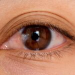 Pterygium Remedy: Practical Ways to Find Relief