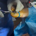 Fungal Nails Treatment: Safe, Effective Relief and Care